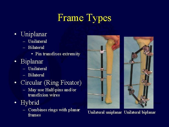 Frame Types • Uniplanar – Unilateral – Bilateral • Pin transfixes extremity • Biplanar