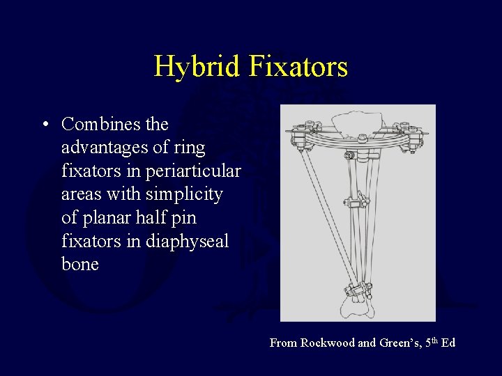 Hybrid Fixators • Combines the advantages of ring fixators in periarticular areas with simplicity Hybrid Fixators • Combines the advantages of ring fixators in periarticular areas with simplicity