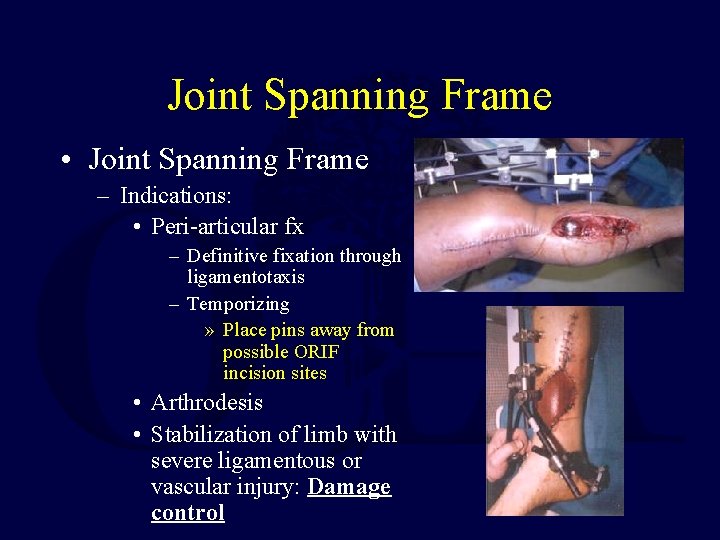 Joint Spanning Frame • Joint Spanning Frame – Indications: • Peri-articular fx – Definitive