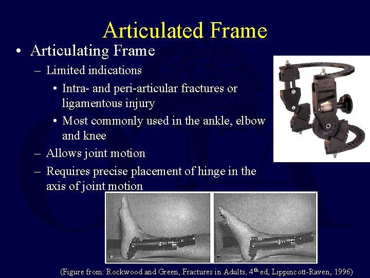 Articulated Frame • Articulating Frame – Limited indications • Intra- and peri-articular fractures or