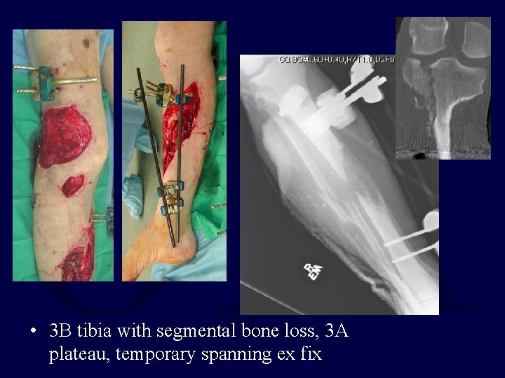 • 3 B tibia with segmental bone loss, 3 A plateau, temporary spanning • 3 B tibia with segmental bone loss, 3 A plateau, temporary spanning