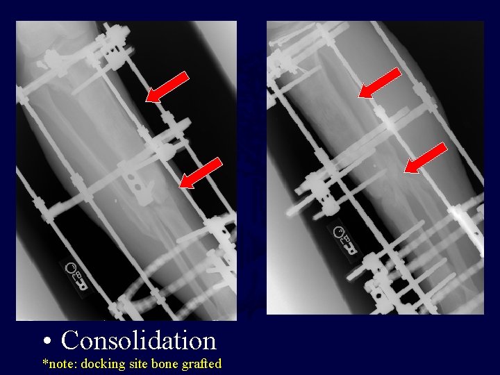  • Consolidation *note: docking site bone grafted 