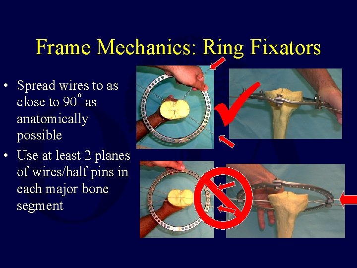 Frame Mechanics: Ring Fixators • Spread wires to as o close to 90 as Frame Mechanics: Ring Fixators • Spread wires to as o close to 90 as