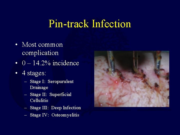 Pin-track Infection • Most common complication • 0 – 14. 2% incidence • 4