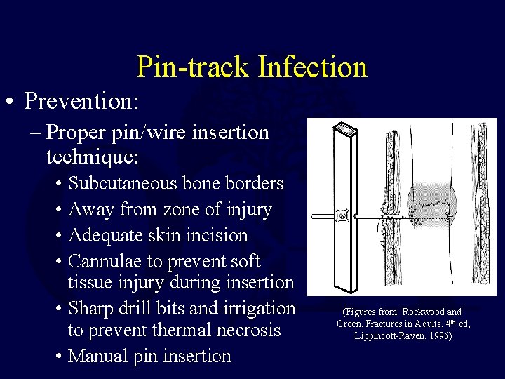 Pin-track Infection • Prevention: – Proper pin/wire insertion technique: • Subcutaneous bone borders •