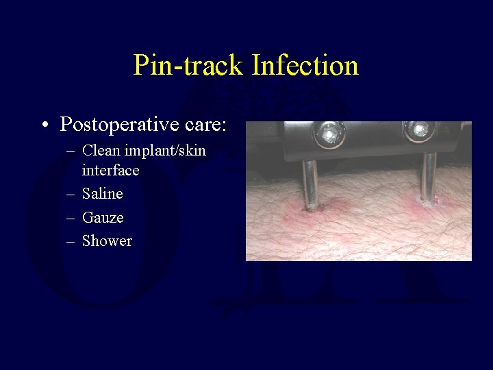 Pin-track Infection • Postoperative care: – Clean implant/skin interface – Saline – Gauze – Pin-track Infection • Postoperative care: – Clean implant/skin interface – Saline – Gauze –
