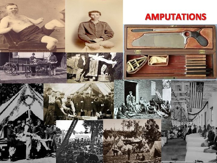 AMPUTATIONS AMPUTATIONS