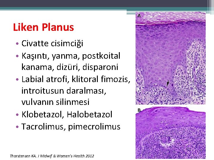 Liken Planus • Civatte cisimciği • Kaşıntı, yanma, postkoital kanama, dizüri, disparoni • Labial Liken Planus • Civatte cisimciği • Kaşıntı, yanma, postkoital kanama, dizüri, disparoni • Labial