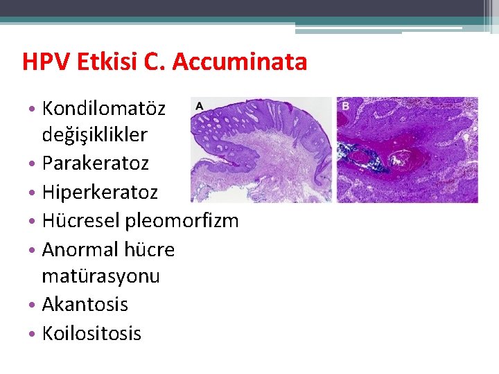 HPV Etkisi C. Accuminata • Kondilomatöz değişiklikler • Parakeratoz • Hiperkeratoz • Hücresel pleomorfizm HPV Etkisi C. Accuminata • Kondilomatöz değişiklikler • Parakeratoz • Hiperkeratoz • Hücresel pleomorfizm