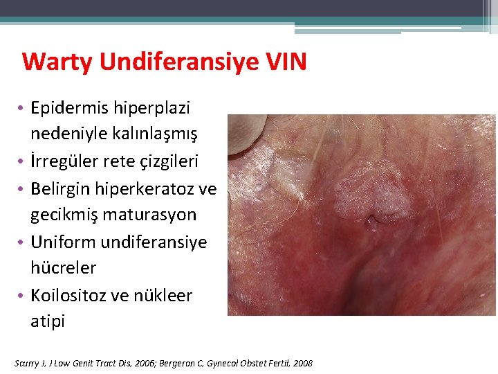 Warty Undiferansiye VIN • Epidermis hiperplazi nedeniyle kalınlaşmış • İrregüler rete çizgileri • Belirgin Warty Undiferansiye VIN • Epidermis hiperplazi nedeniyle kalınlaşmış • İrregüler rete çizgileri • Belirgin