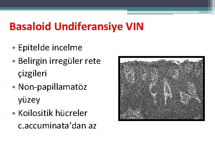 Basaloid Undiferansiye VIN • Epitelde incelme • Belirgin irregüler rete çizgileri • Non-papillamatöz yüzey Basaloid Undiferansiye VIN • Epitelde incelme • Belirgin irregüler rete çizgileri • Non-papillamatöz yüzey
