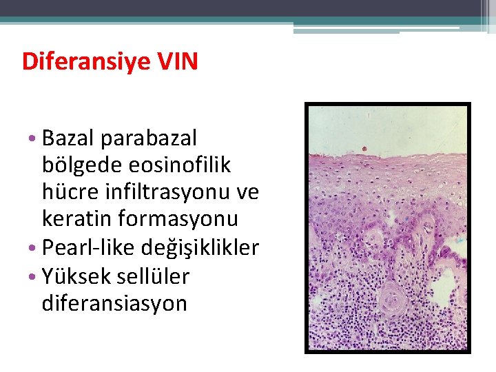 Diferansiye VIN • Bazal parabazal bölgede eosinofilik hücre infiltrasyonu ve keratin formasyonu • Pearl-like Diferansiye VIN • Bazal parabazal bölgede eosinofilik hücre infiltrasyonu ve keratin formasyonu • Pearl-like