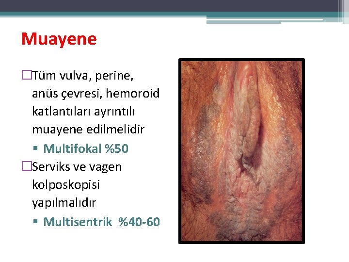 Muayene �Tüm vulva, perine, anüs çevresi, hemoroid katlantıları ayrıntılı muayene edilmelidir Multifokal %50 �Serviks Muayene �Tüm vulva, perine, anüs çevresi, hemoroid katlantıları ayrıntılı muayene edilmelidir Multifokal %50 �Serviks