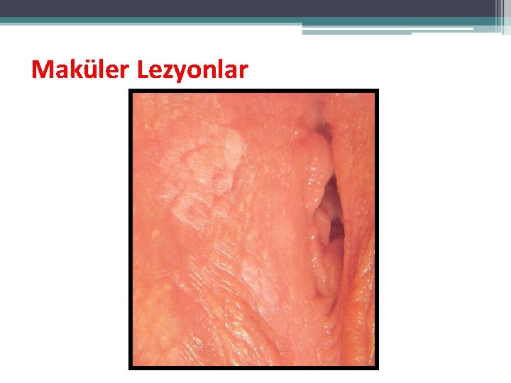Maküler Lezyonlar Maküler Lezyonlar