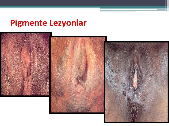 Pigmente Lezyonlar Pigmente Lezyonlar