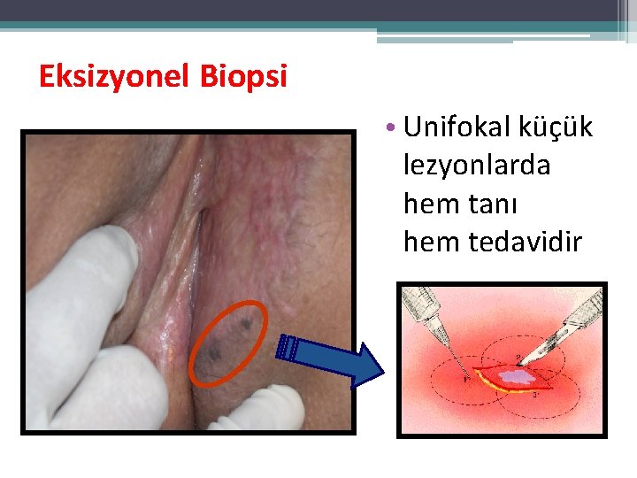 Eksizyonel Biopsi • Unifokal küçük lezyonlarda hem tanı hem tedavidir Eksizyonel Biopsi • Unifokal küçük lezyonlarda hem tanı hem tedavidir