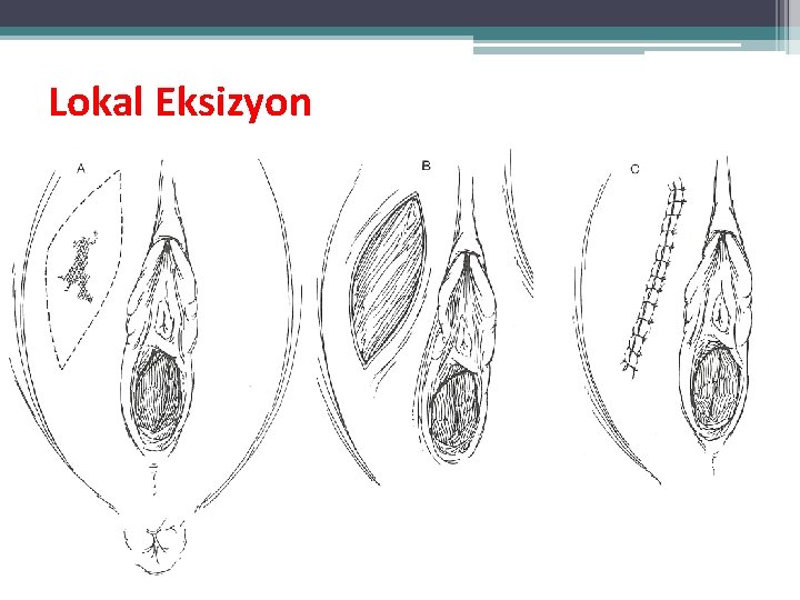 Lokal Eksizyon Lokal Eksizyon