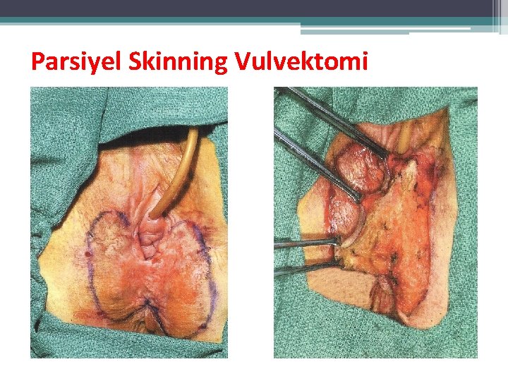 Parsiyel Skinning Vulvektomi Parsiyel Skinning Vulvektomi