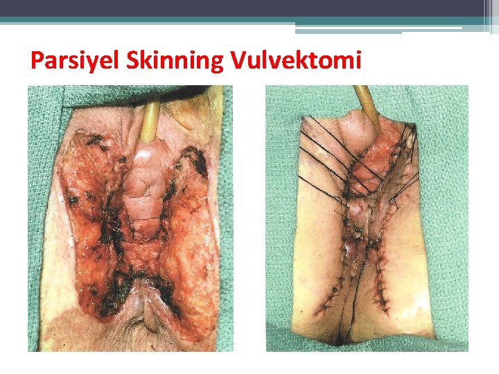 Parsiyel Skinning Vulvektomi Parsiyel Skinning Vulvektomi