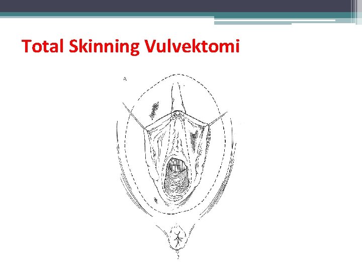 Total Skinning Vulvektomi Total Skinning Vulvektomi