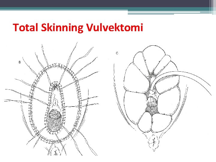 Total Skinning Vulvektomi Total Skinning Vulvektomi