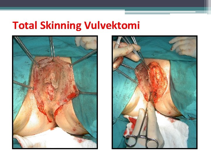 Total Skinning Vulvektomi Total Skinning Vulvektomi