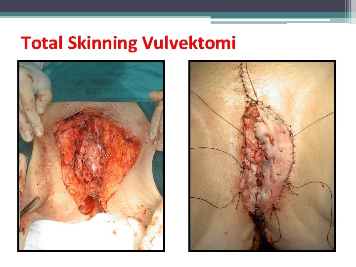 Total Skinning Vulvektomi Total Skinning Vulvektomi