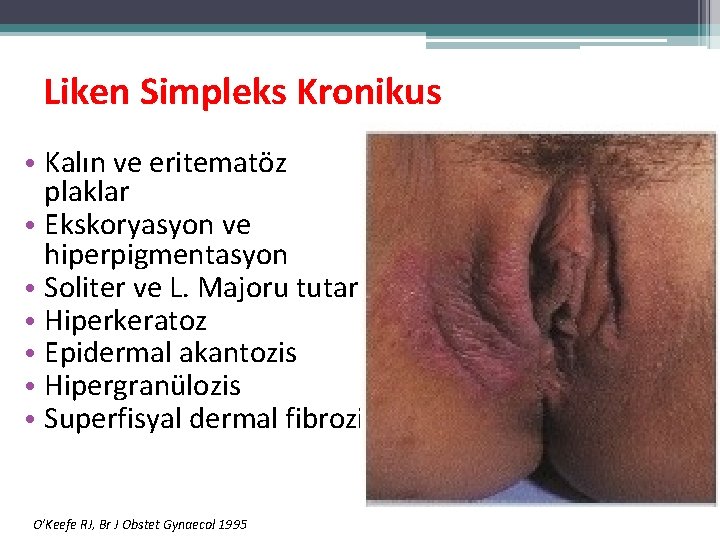 Liken Simpleks Kronikus • Kalın ve eritematöz plaklar • Ekskoryasyon ve hiperpigmentasyon • Soliter Liken Simpleks Kronikus • Kalın ve eritematöz plaklar • Ekskoryasyon ve hiperpigmentasyon • Soliter