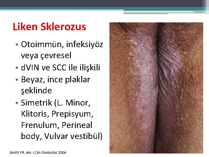 Liken Sklerozus • Otoimmün, infeksiyöz veya çevresel • d. VIN ve SCC ile ilişkili Liken Sklerozus • Otoimmün, infeksiyöz veya çevresel • d. VIN ve SCC ile ilişkili
