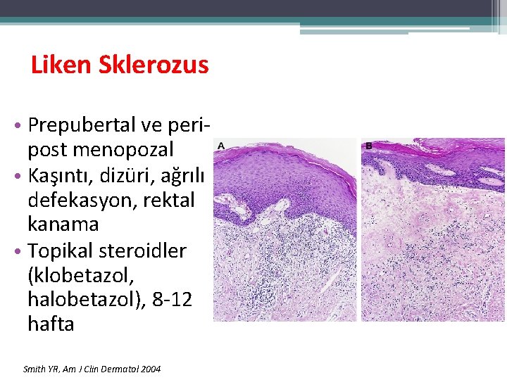 Liken Sklerozus • Prepubertal ve peripost menopozal • Kaşıntı, dizüri, ağrılı defekasyon, rektal kanama Liken Sklerozus • Prepubertal ve peripost menopozal • Kaşıntı, dizüri, ağrılı defekasyon, rektal kanama