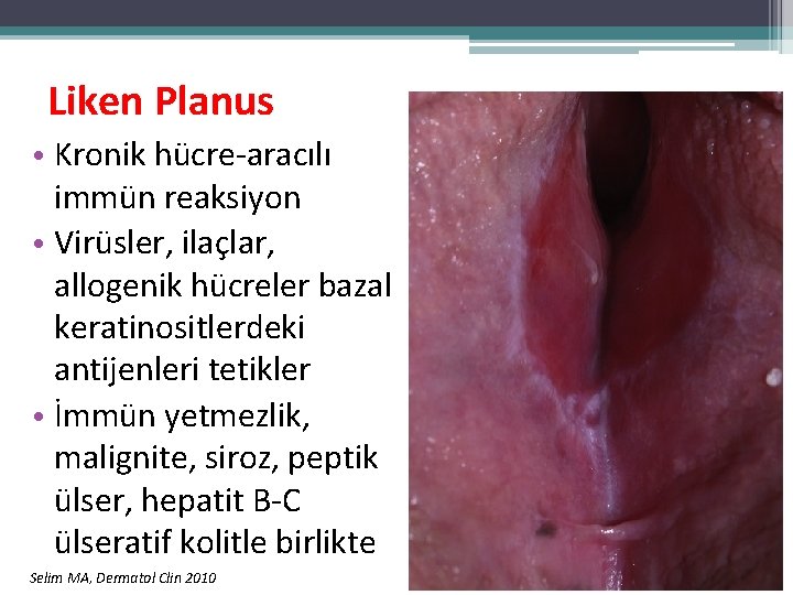 Liken Planus • Kronik hücre-aracılı immün reaksiyon • Virüsler, ilaçlar, allogenik hücreler bazal keratinositlerdeki Liken Planus • Kronik hücre-aracılı immün reaksiyon • Virüsler, ilaçlar, allogenik hücreler bazal keratinositlerdeki