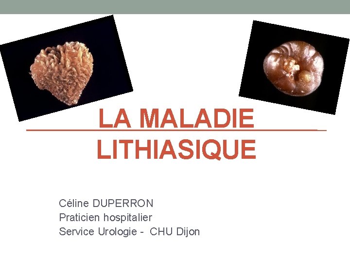 LA MALADIE LITHIASIQUE Céline DUPERRON Praticien hospitalier Service Urologie - CHU Dijon 