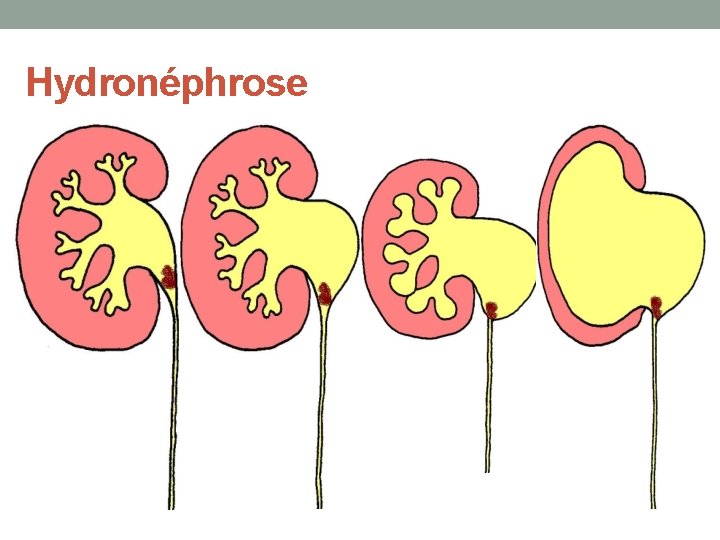 Hydronéphrose 