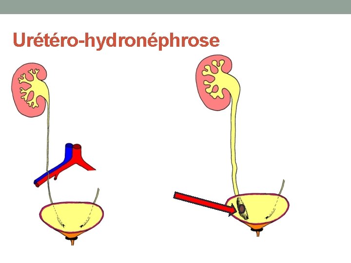 Urétéro-hydronéphrose 