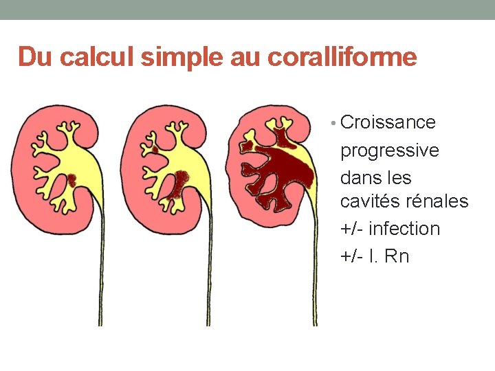 Du calcul simple au coralliforme • Croissance progressive dans les cavités rénales +/- infection