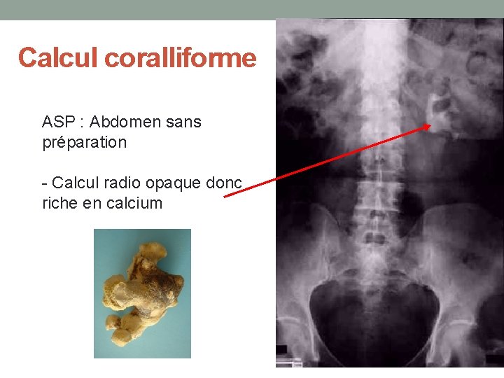Calcul coralliforme ASP : Abdomen sans préparation - Calcul radio opaque donc riche en