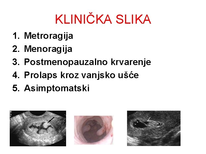 KLINIČKA SLIKA 1. 2. 3. 4. 5. Metroragija Menoragija Postmenopauzalno krvarenje Prolaps kroz vanjsko KLINIČKA SLIKA 1. 2. 3. 4. 5. Metroragija Menoragija Postmenopauzalno krvarenje Prolaps kroz vanjsko