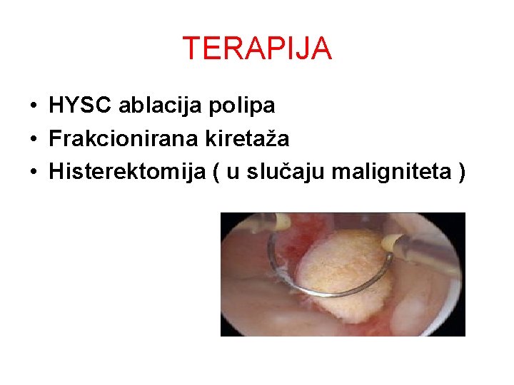 TERAPIJA • HYSC ablacija polipa • Frakcionirana kiretaža • Histerektomija ( u slučaju maligniteta TERAPIJA • HYSC ablacija polipa • Frakcionirana kiretaža • Histerektomija ( u slučaju maligniteta