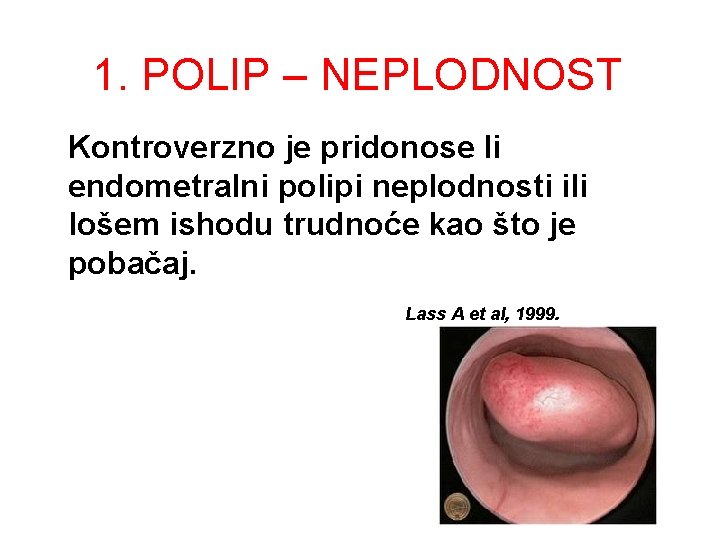 1. POLIP – NEPLODNOST Kontroverzno je pridonose li endometralni polipi neplodnosti ili lošem ishodu 1. POLIP – NEPLODNOST Kontroverzno je pridonose li endometralni polipi neplodnosti ili lošem ishodu