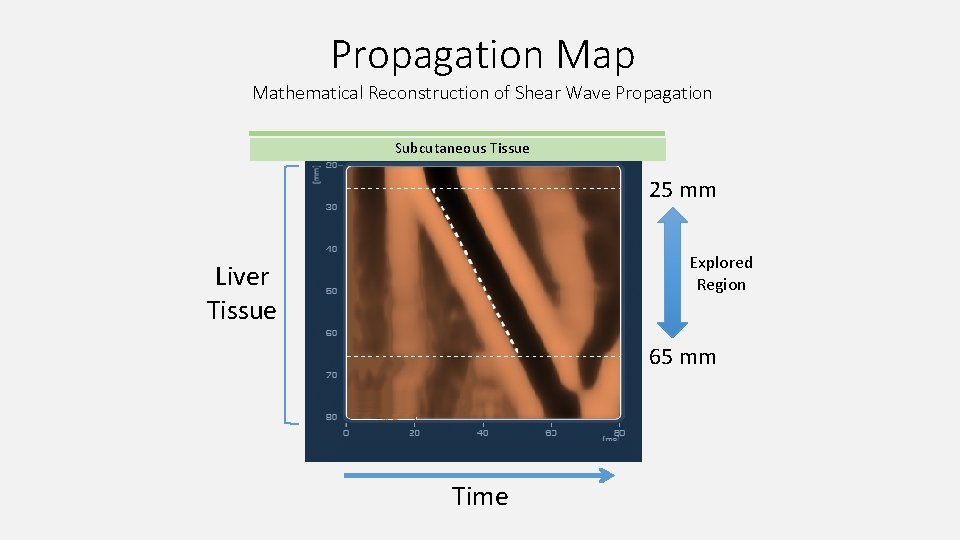 Propagation Map Mathematical Reconstruction of Shear Wave Propagation Subcutaneous Tissue 25 mm Explored Region