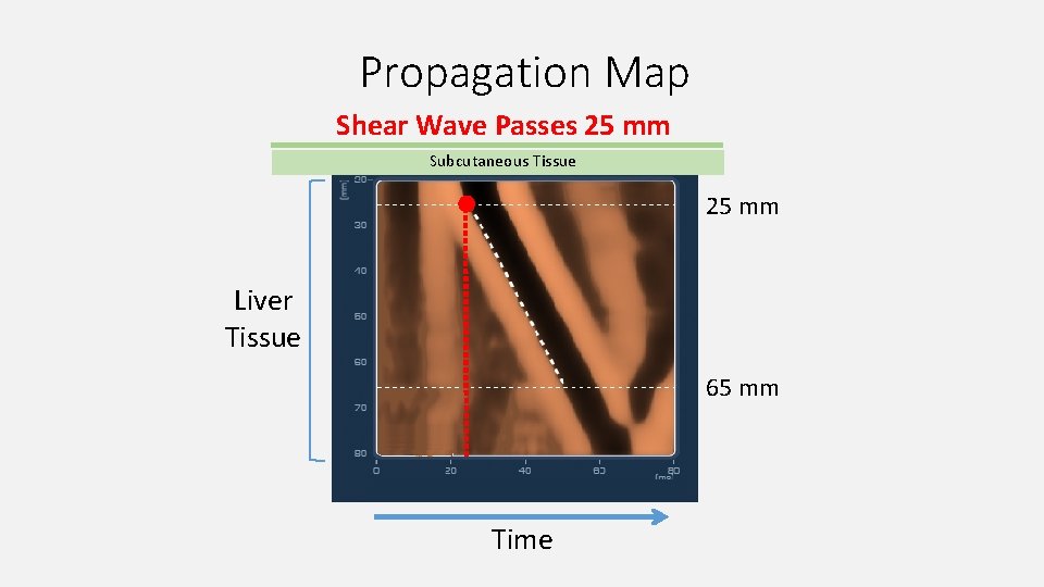 Propagation Map Shear Wave Passes 25 mm Subcutaneous Tissue 25 mm Liver Tissue 65