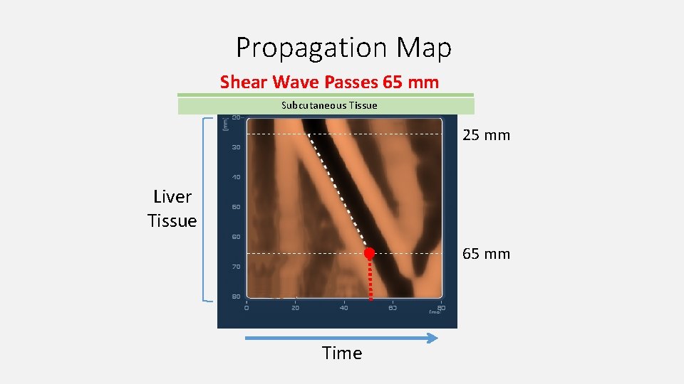 Propagation Map Shear Wave Passes 65 mm Subcutaneous Tissue 25 mm Liver Tissue 65