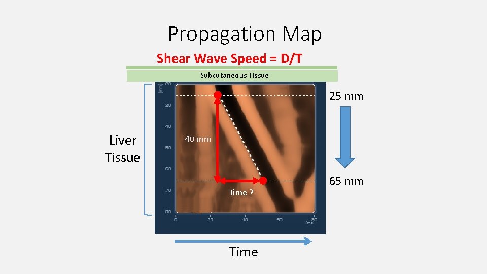 Propagation Map Shear Wave Speed = D/T Subcutaneous Tissue 25 mm Liver Tissue 40