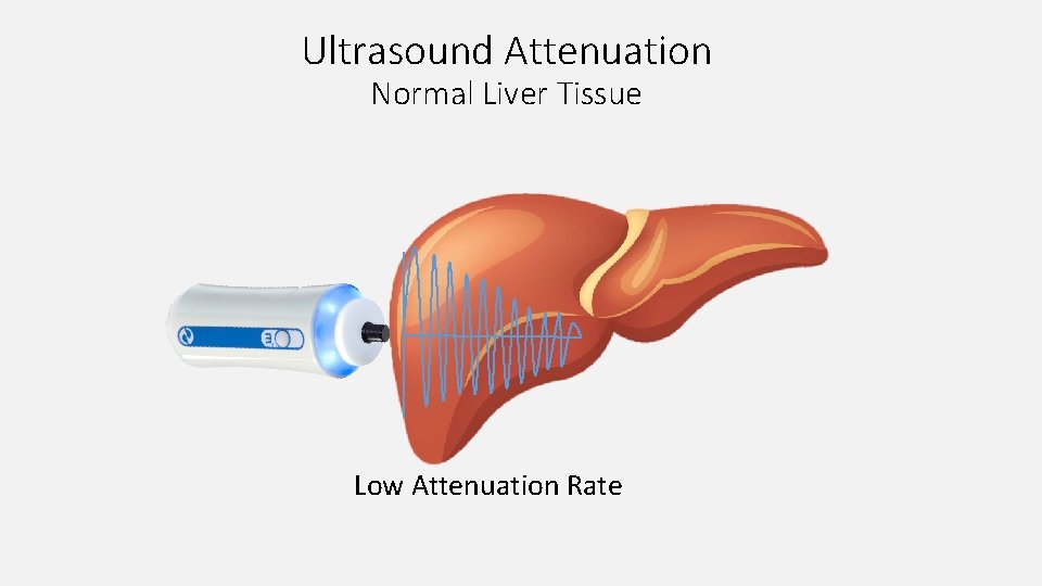 Ultrasound Attenuation Normal Liver Tissue Low Attenuation Rate 