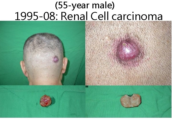 (55 -year male) 1995 -08: Renal Cell carcinoma 