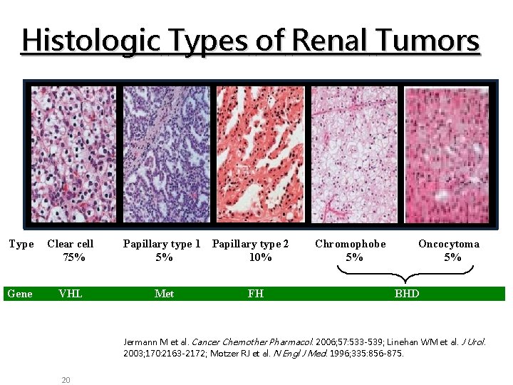 Histologic Types of Renal Tumors Type Clear cell 75% Gene VHL Papillary type 1