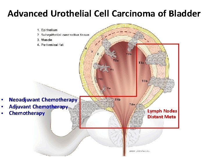 Advanced Urothelial Cell Carcinoma of Bladder • • • Neoadjuvant Chemotherapy Adjuvant Chemotherapy Lymph
