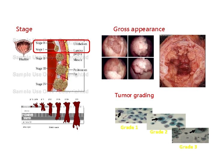 Stage Gross appearance Tumor grading Grade 1 Grade 2 Grade 3 