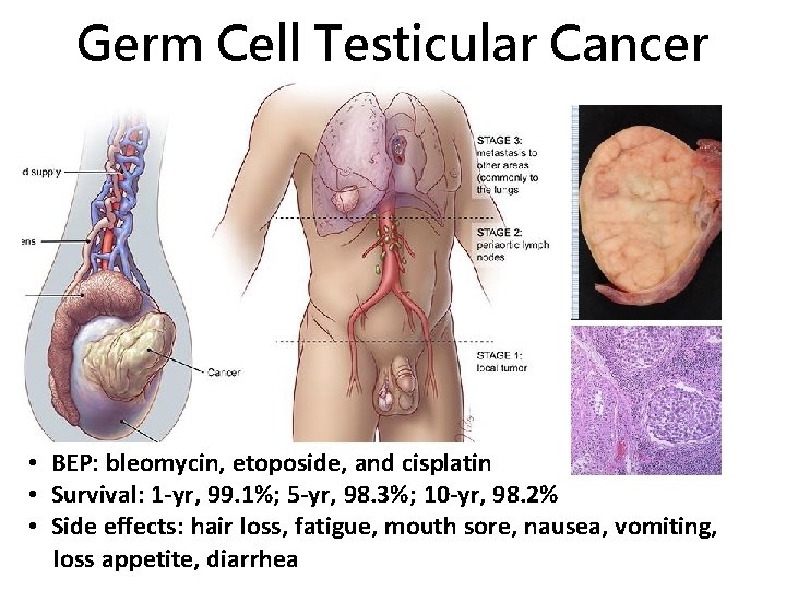 Germ Cell Testicular Cancer • BEP: bleomycin, etoposide, and cisplatin • Survival: 1 -yr,