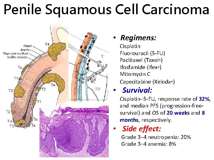 Penile Squamous Cell Carcinoma • Regimens: Cisplatin Fluorouracil (5 -FU) Paclitaxel (Taxol®) Ifosfamide (Ifex®)